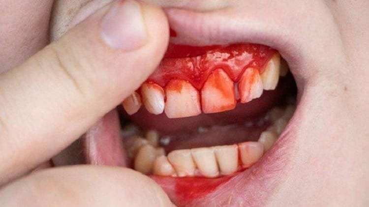 Panduan Lengkap Mengenal Gusi Berdarah Penyebab Gejala Pencegahan Dan Penanganan